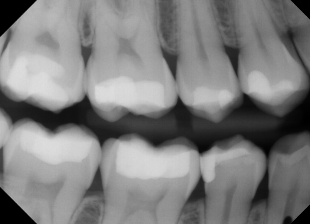 filling tooth fillings hurt does why getting sensitive mouth