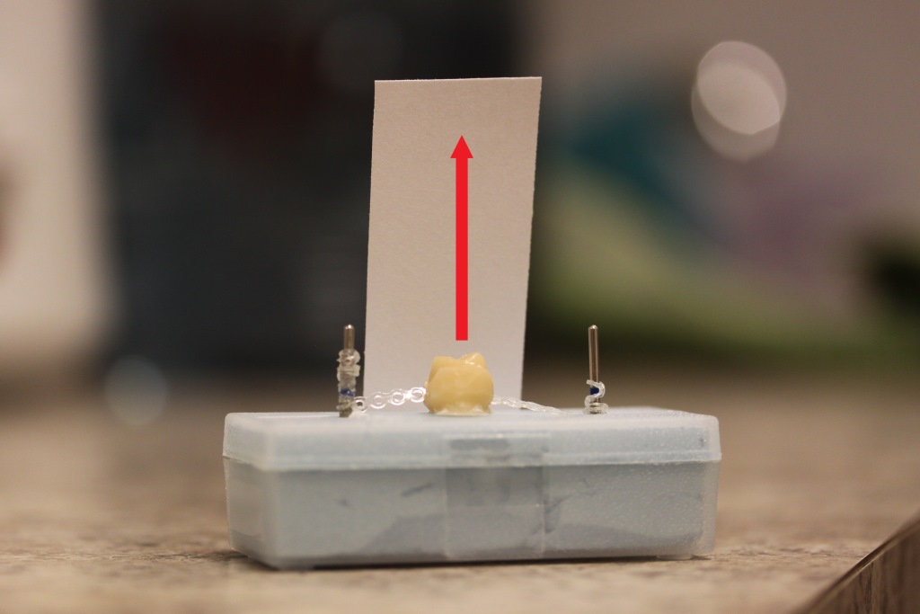 What To Do When A Crown Comes Off The Healthy Mouth Project