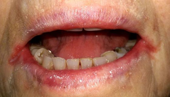 Angular_cheilitis1