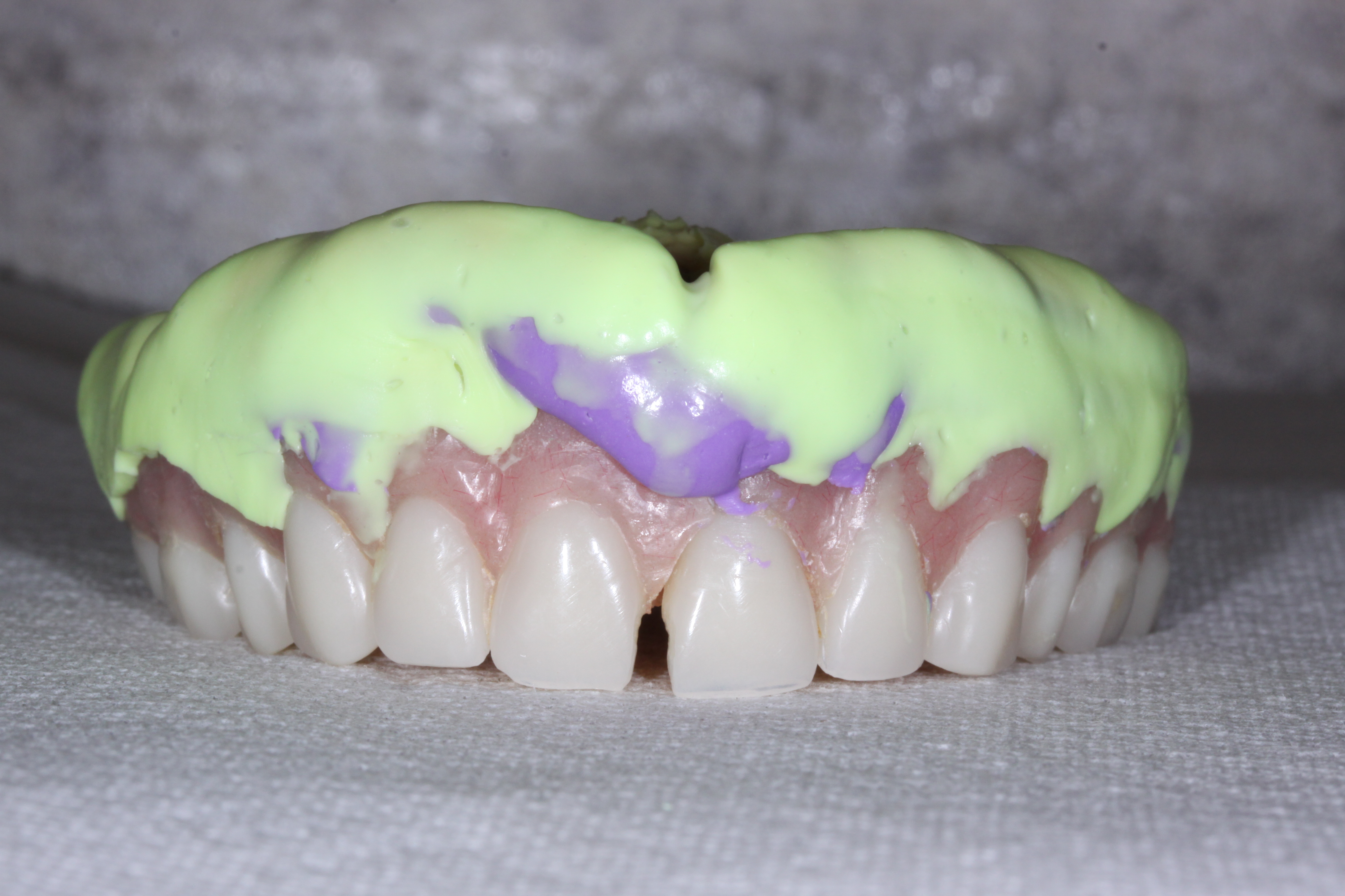 When Can You Repair A Denture? The Healthy Mouth Project