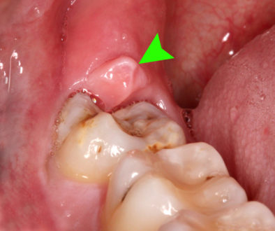 pericoronitis