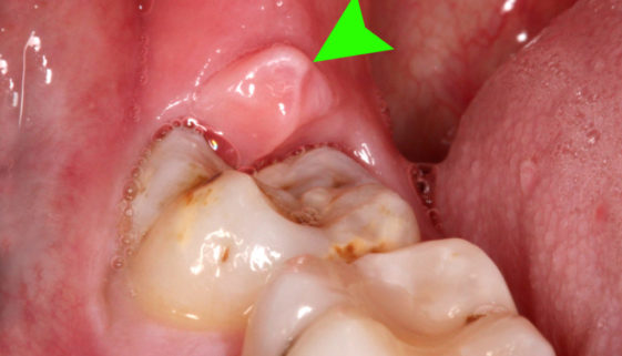 pericoronitis