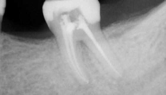 root-canal